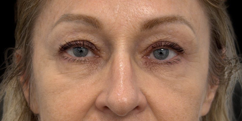 Dopo — blépharoplastie inférieure (poches sous les yeux)
