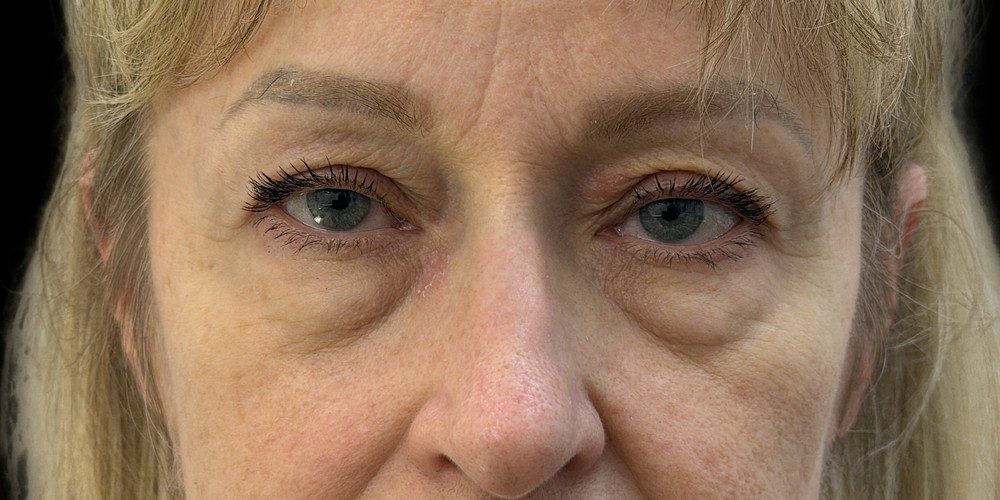 Prima — blépharoplastie inférieure (poches sous les yeux)