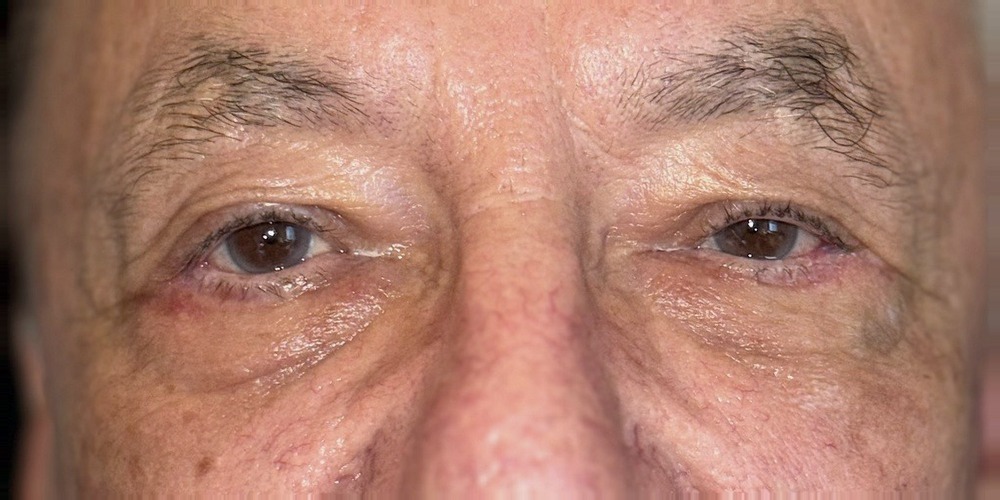 Dopo — blépharoplastie inférieure
