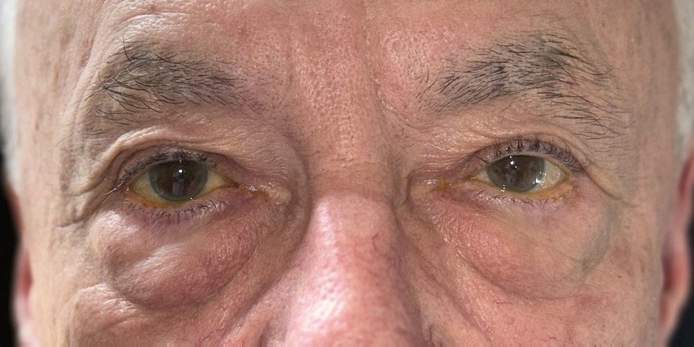 Prima — blépharoplastie inférieure