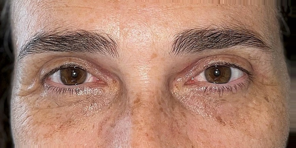 Dopo — blépharoplastie supérieure