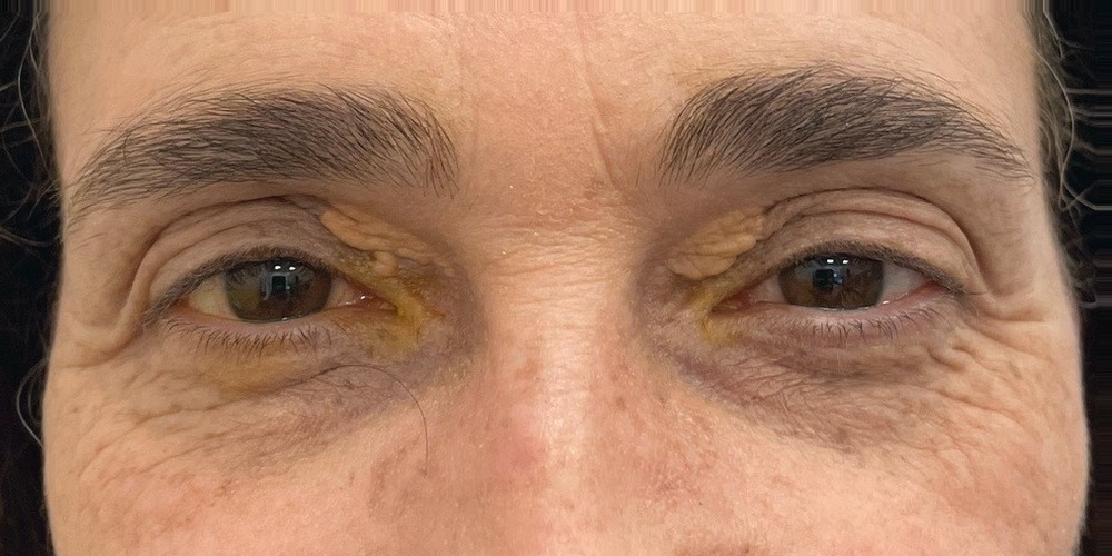 Prima — blépharoplastie supérieure