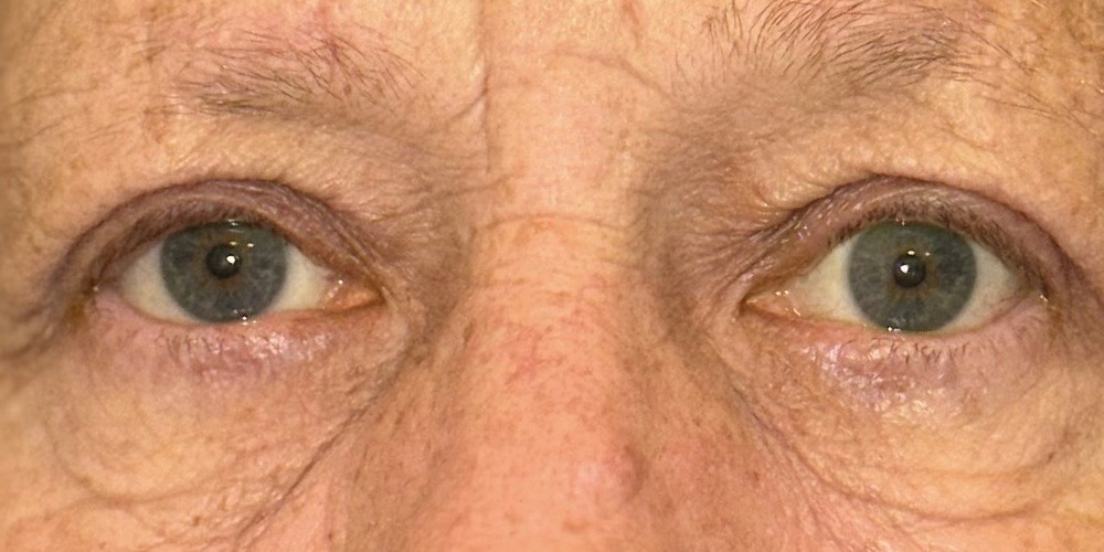 Dopo — blépharoplastie supérieure