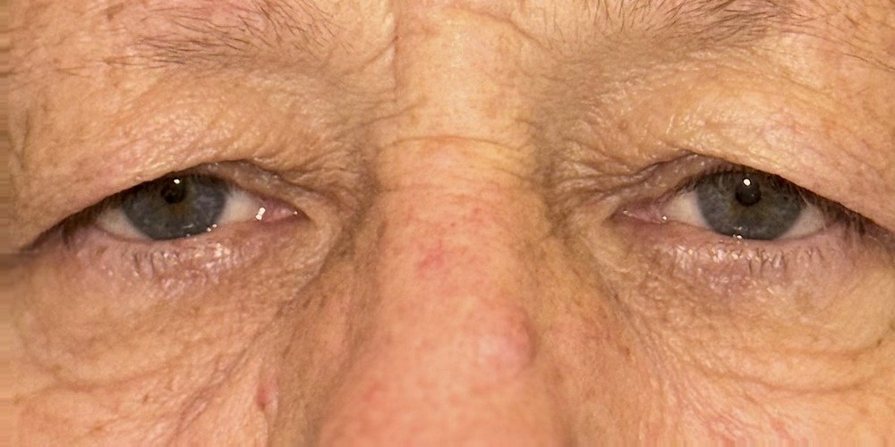 Prima — blépharoplastie supérieure