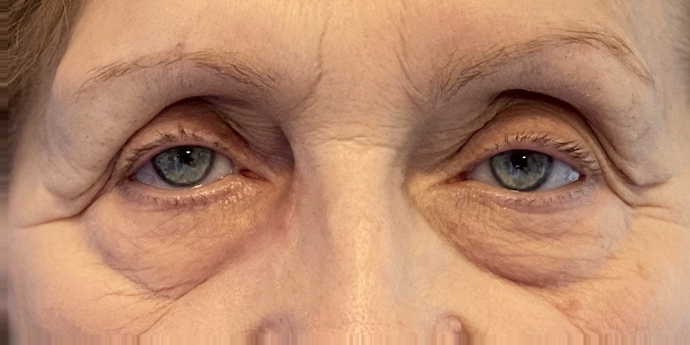 After — dacryocystorhinostomie