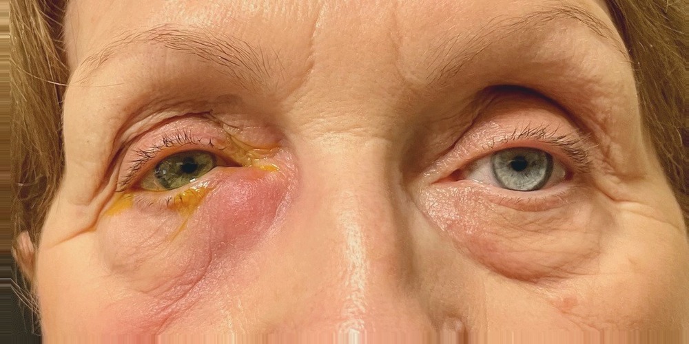 Before — dacryocystorhinostomie