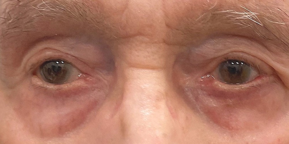 After — cure d'ectropion