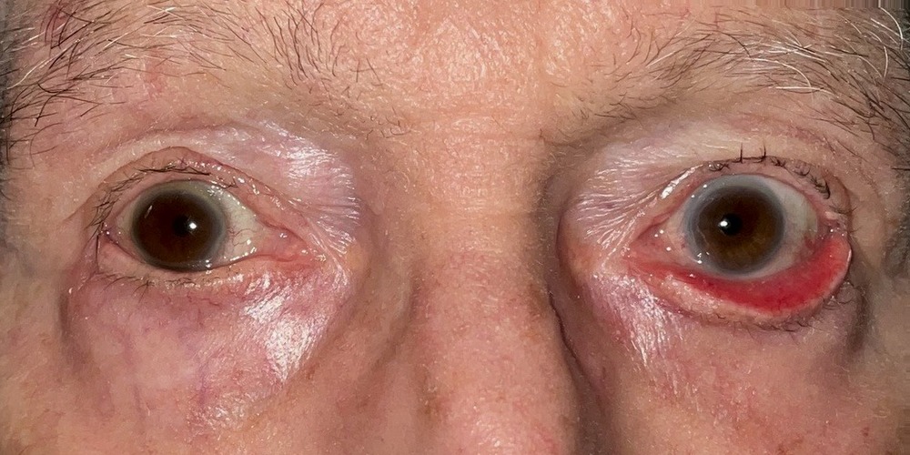 Before — cure d'ectropion