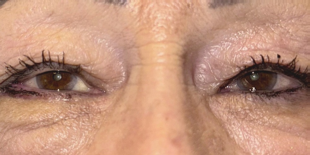 After — cure d'entropion