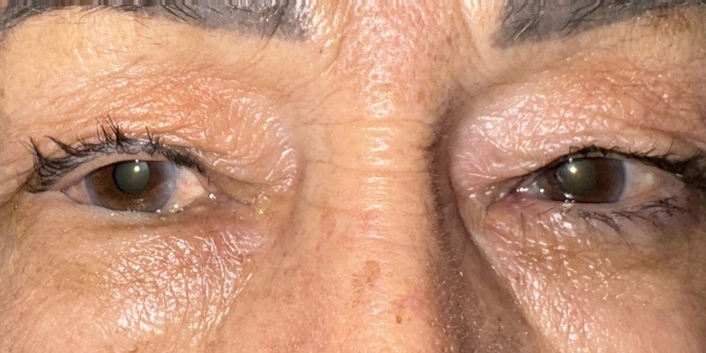 Before — cure d'entropion