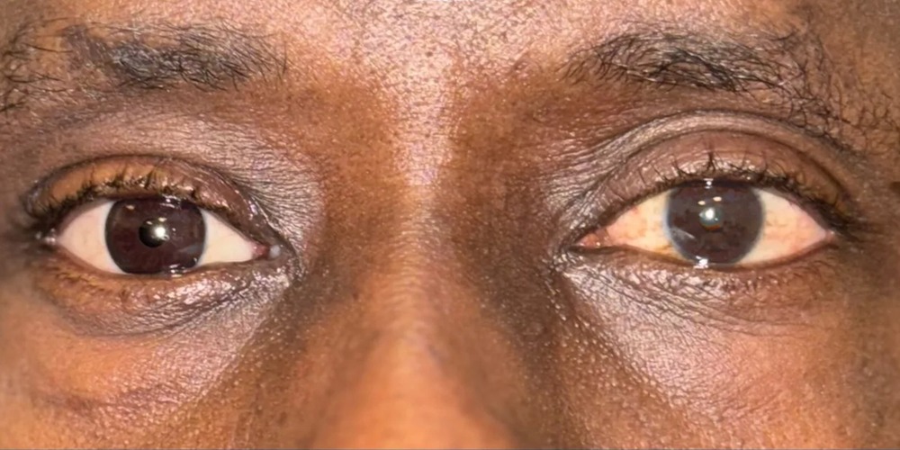 After — éviscération avec prothèse oculaire