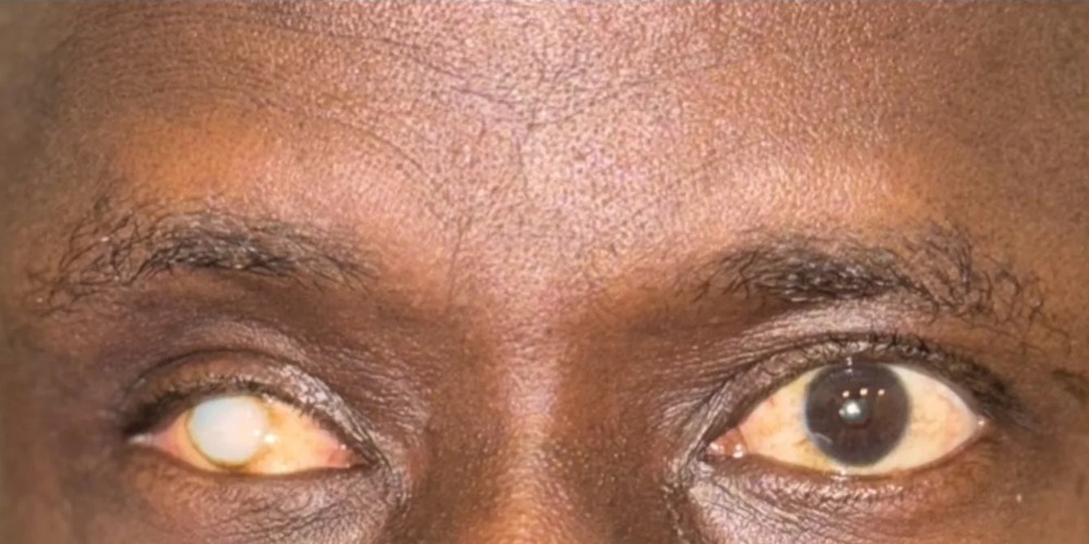 Before — éviscération avec prothèse oculaire