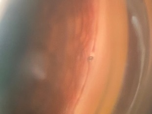 Glaucoma, stent, cataract