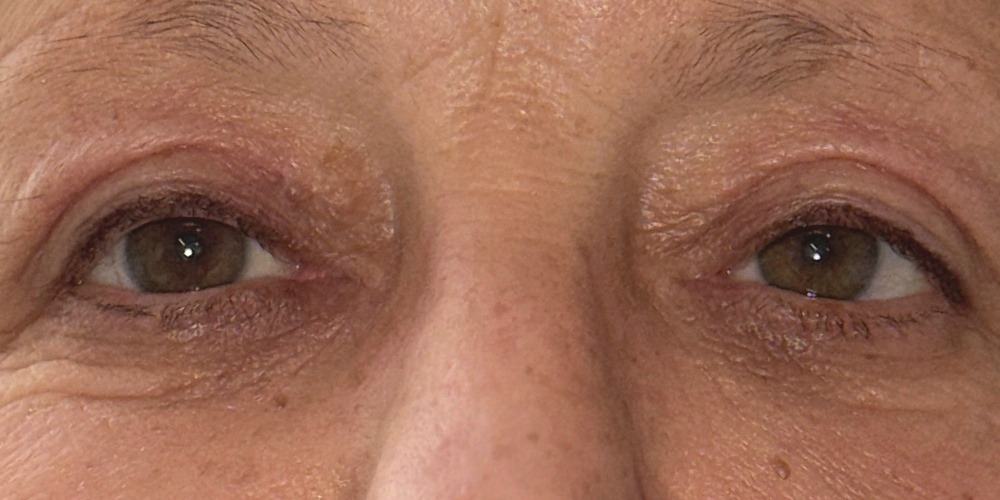 After — chirurgie d'un ptosis bilatéral