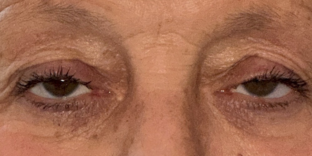 Before — chirurgie d'un ptosis bilatéral