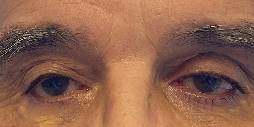 After — chirurgie du ptosis de l'œil droit