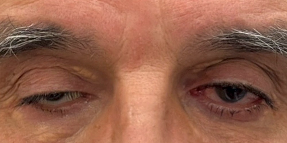 Before — chirurgie du ptosis de l'œil droit