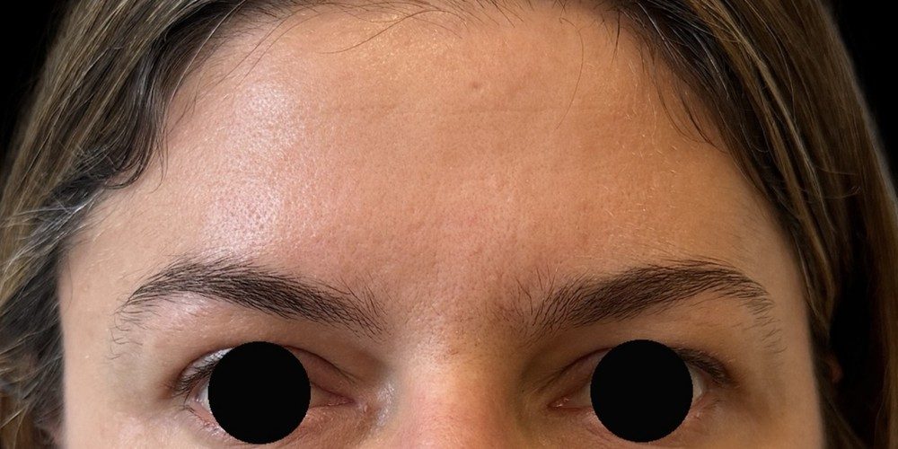 Dopo — injections de toxine botulique