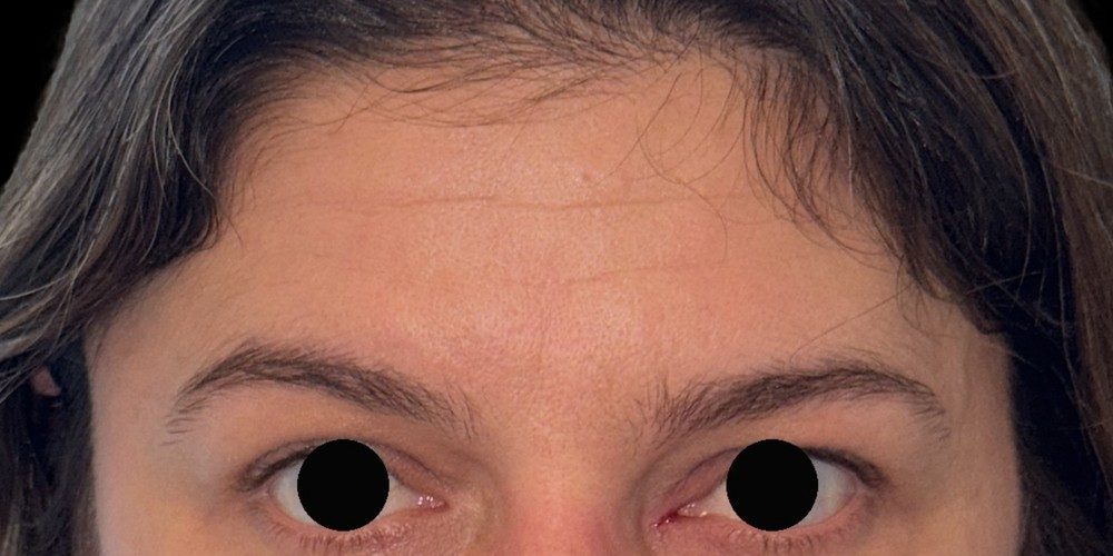 Prima — injections de toxine botulique