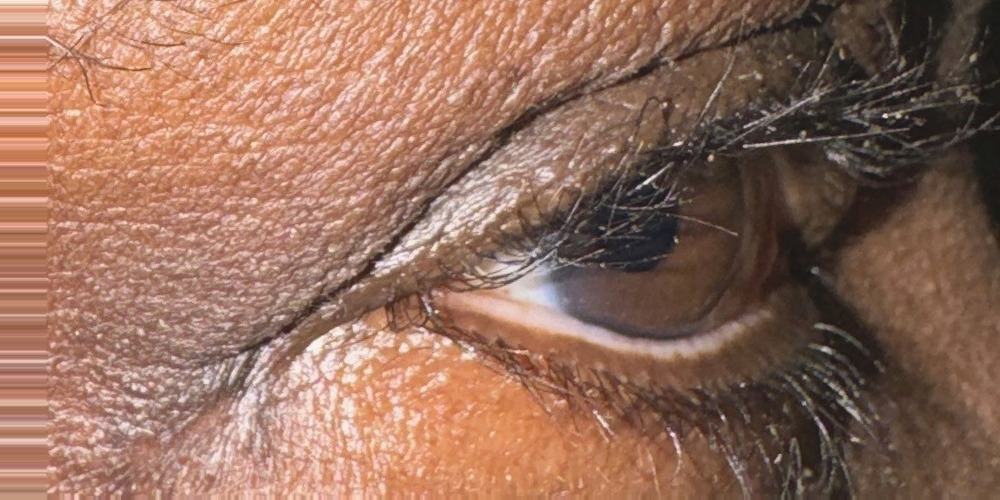 After — exérèse d'une tumeur bénigne de la paupière inférieure