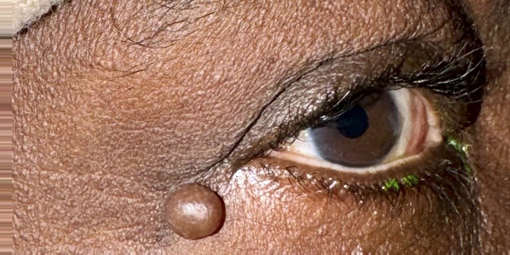 Before — exérèse d'une tumeur bénigne de la paupière inférieure