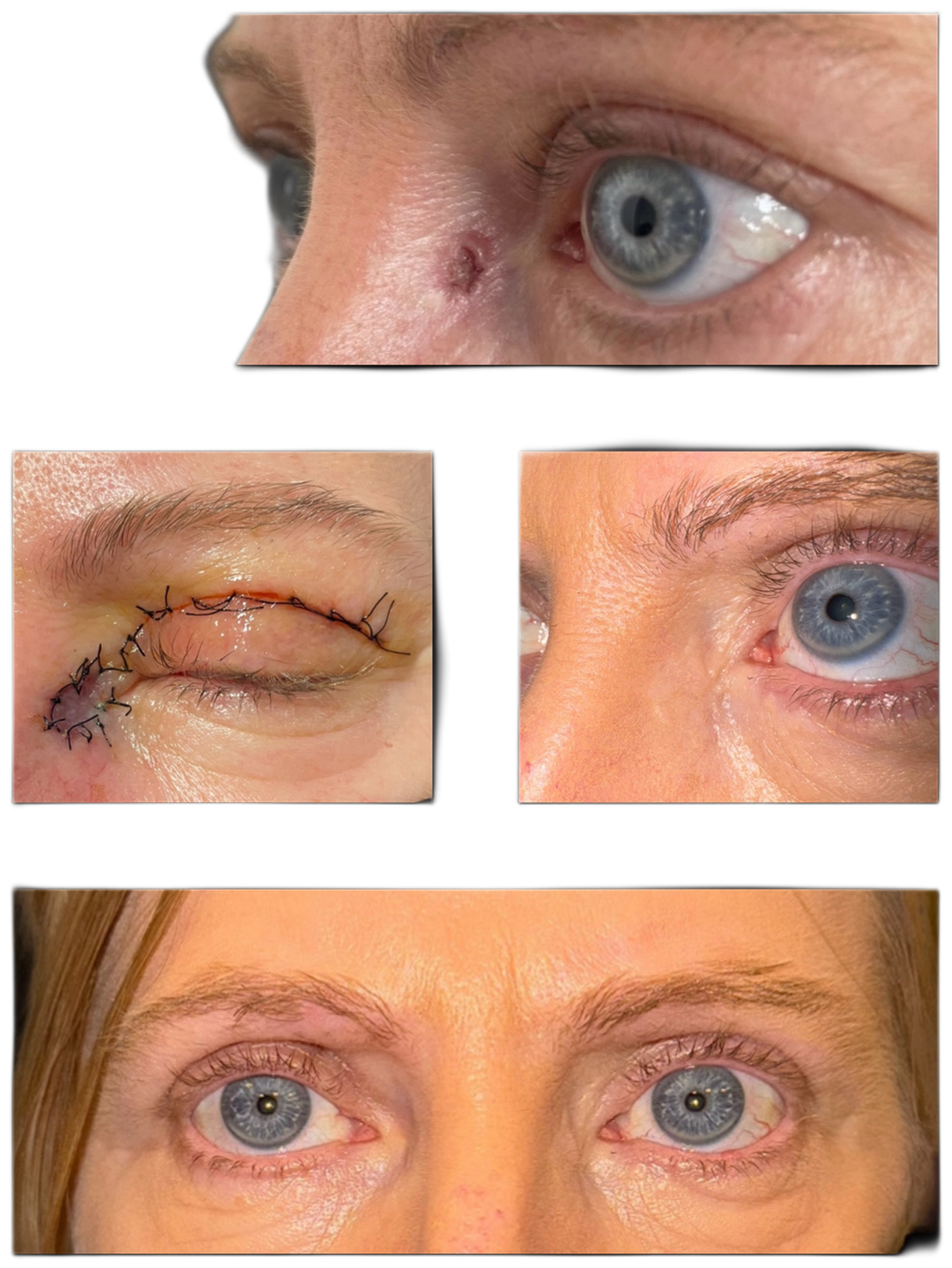 Eyelid tumours / skin graft: before / after